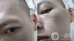 自體細胞注射去痘坑*嗎?