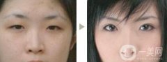 做雙眼皮手術(shù)*嗎?術(shù)前注意事項(xiàng)盤點(diǎn)