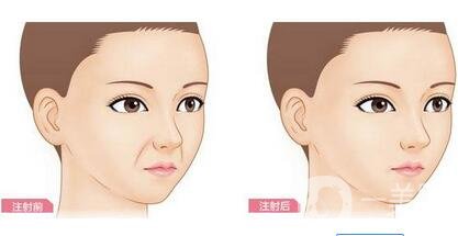 注射豐鼻唇溝*果*嗎？能立馬*果嗎？