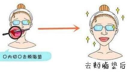 去頰脂墊價格貴嗎？大概價位是多少？