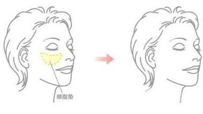 去頰脂墊價格貴嗎？大概價位是多少？