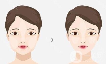 去頰脂墊價格貴嗎？大概價位是多少？