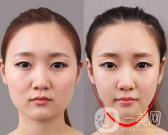 去頰脂墊有副作用嗎？術(shù)后如何護(hù)理可以減小副作用？