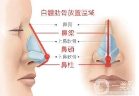 韓式肋骨隆鼻手術(shù)多少錢？*果怎樣？