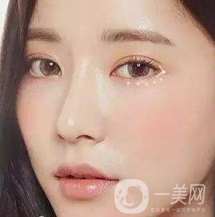 *需要拆線嗎？多長(zhǎng)時(shí)間可以碰水？