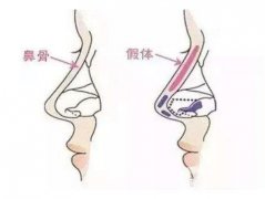 假體隆鼻整型術(shù)術(shù)前準備有哪些？