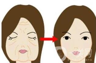 冰電波拉皮除皺*果如何？有哪些優(yōu)點(diǎn)？