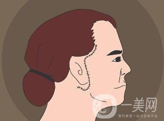 冰電波拉皮除皺*果如何？有哪些優(yōu)點(diǎn)？