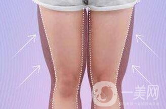 大腿環(huán)形吸脂多久恢復(fù)？會(huì)有疤嗎？