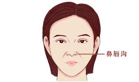 鼻唇溝填充術一般用什么材料?哪種材料比較好?