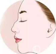 如何讓鼻梁變高？可以注射玻尿酸嗎？