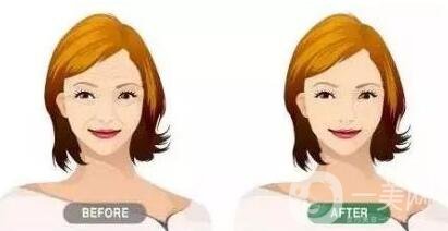 瑞蘭玻尿酸注射除皺價(jià)格要多少錢？