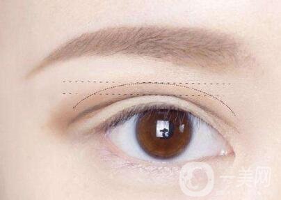 三點定位雙眼皮手術后應該注意些什么？