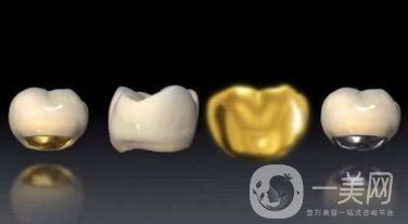 貴金屬烤瓷牙有哪些種類？