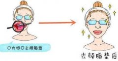 去頰脂墊價格貴不貴?收費情況說明