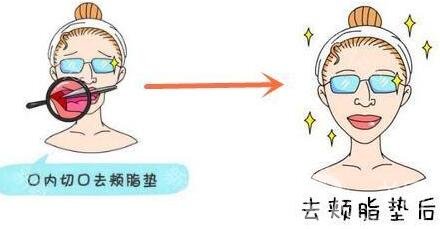 去頰脂墊價格貴不貴?收費(fèi)情況說明