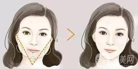 去頰脂墊價格貴不貴?收費(fèi)情況說明
