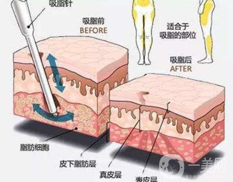 全身抽脂減肥價格大概要多少錢？