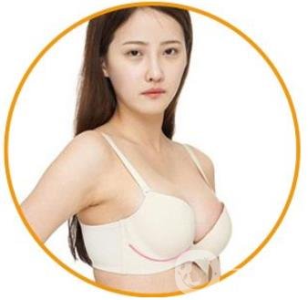娜綺麗隆胸多久變軟？怎么加速變軟？
