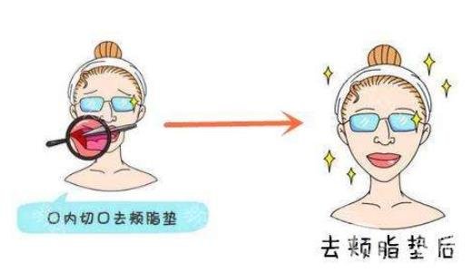 去頰脂墊*果怎么樣？*嗎？