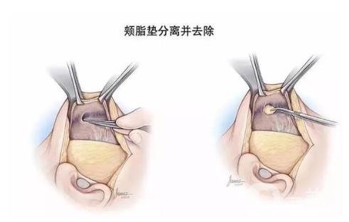 去頰脂墊*果怎么樣？*嗎？