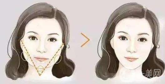 去頰脂墊*果怎么樣？*嗎？