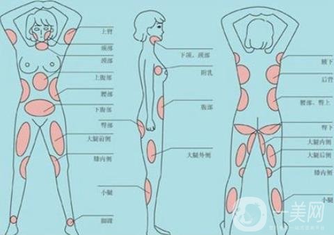 全身抽脂減肥多少錢？貴嗎？