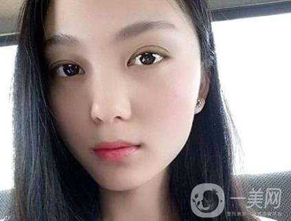 吸雕雙眼皮手術(shù)是什么？是埋線嗎？