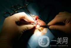 做唇裂手術(shù)多少錢(qián)?要做幾次?