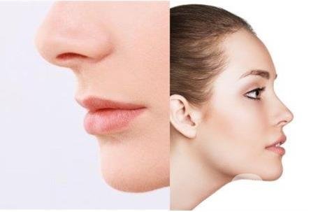怎樣讓鼻子變高？隆鼻可以讓鼻子變高嗎？