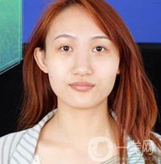 長(zhǎng)沙微恩醫(yī)療整形醫(yī)院 隆鼻