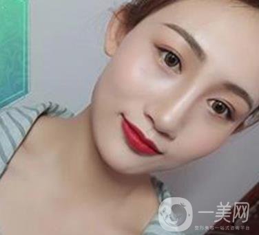 長(zhǎng)沙微恩醫(yī)療整形醫(yī)院 隆鼻