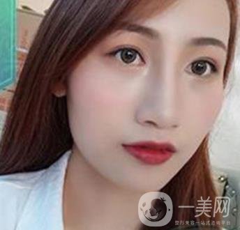 長(zhǎng)沙微恩醫(yī)療整形醫(yī)院 隆鼻