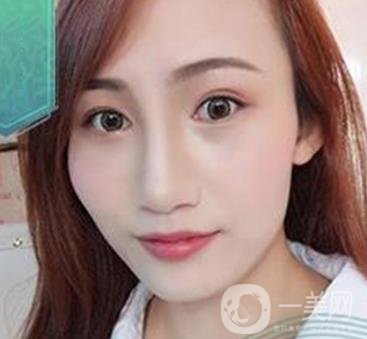 長(zhǎng)沙微恩醫(yī)療整形醫(yī)院 隆鼻