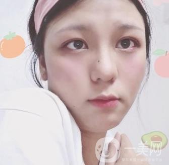 六盤(pán)水友好整形醫(yī)院雙眼皮