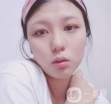 六盤(pán)水友好整形醫(yī)院雙眼皮