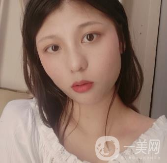 六盤(pán)水友好整形醫(yī)院雙眼皮
