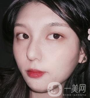 六盤(pán)水友好整形醫(yī)院雙眼皮