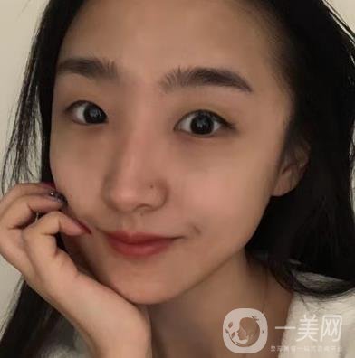 吉大一院整形外科價(jià)格表明細(xì)公布，隆鼻紀(jì)實(shí)案例分享