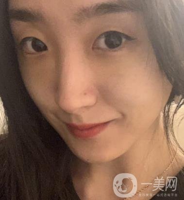 吉大一院整形外科價(jià)格表明細(xì)公布，隆鼻紀(jì)實(shí)案例分享