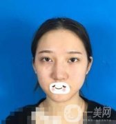 廣州禾麗醫(yī)院做雙眼皮怎么樣?看果圖和價(jià)格表