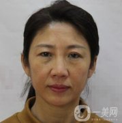 安徽醫(yī)科大學(xué)第(一)附屬醫(yī)院整形外科價(jià)格表，附去眼袋案例