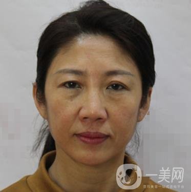 安徽醫(yī)科大學(xué)第(一)附屬醫(yī)院整形外科價(jià)格表，附去眼袋案例