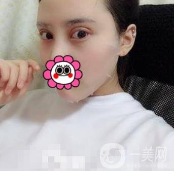 溫嶺芘麗芙整形醫(yī)院2020年價(jià)格表更新_雙眼皮整形*果實(shí)拍