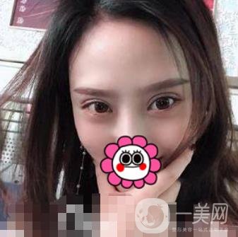 溫嶺芘麗芙整形醫(yī)院2020年價(jià)格表更新_雙眼皮整形*果實(shí)拍