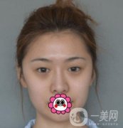 延吉金光善整形美容醫(yī)院價(jià)格表收費(fèi)明細(xì)_雙眼皮手術(shù)真人體驗(yàn)分享