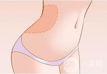 腰腹吸脂是局麻還是全麻?手術(shù)過(guò)程中會(huì)痛嗎?