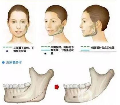 整形科普|下頜角整形手術(shù)的并發(fā)癥和適合人群
