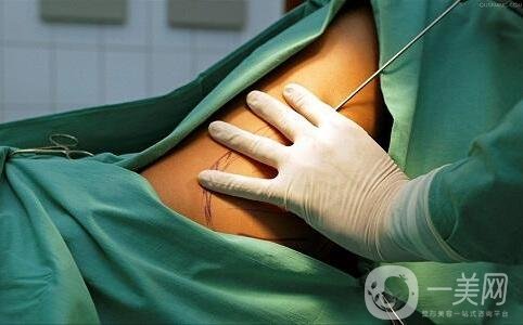 關(guān)于吸脂手術(shù)的流程與*性，你都知道嗎？