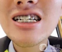 濰坊市人民醫(yī)院整牙多少錢？牙齒矯正價格及果展示